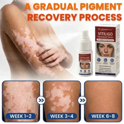 Sylovona Glow™ Vitiligo Treatment Spray for targeted skincare