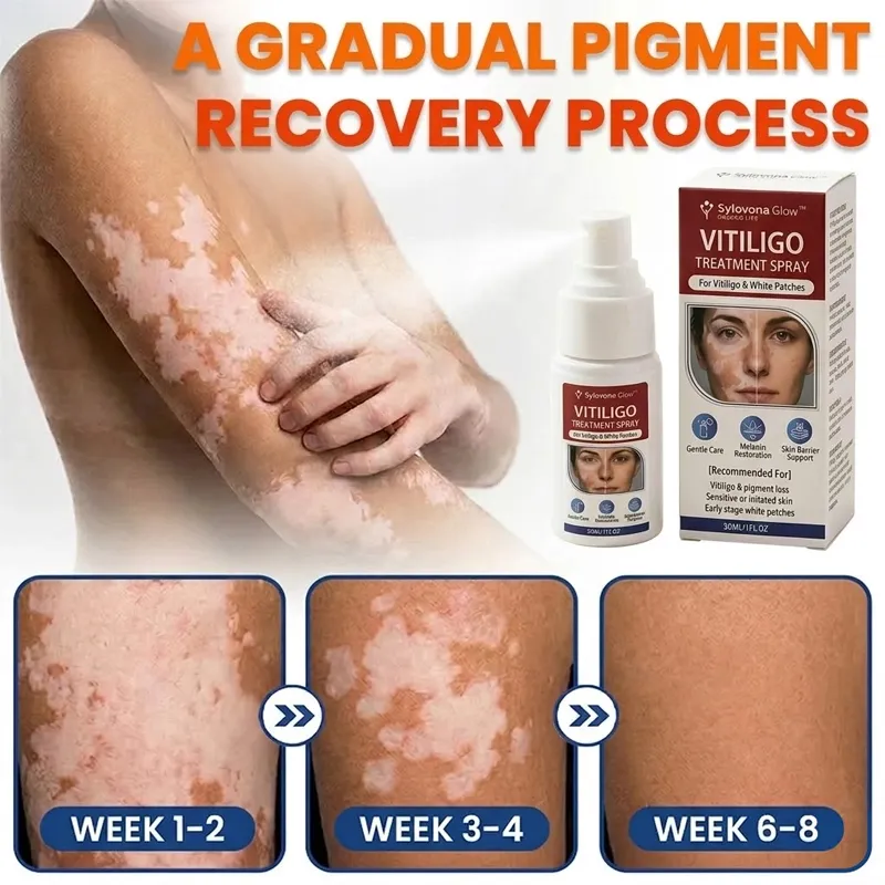 Sylovona Glow™ Vitiligo Treatment Spray for targeted skincare