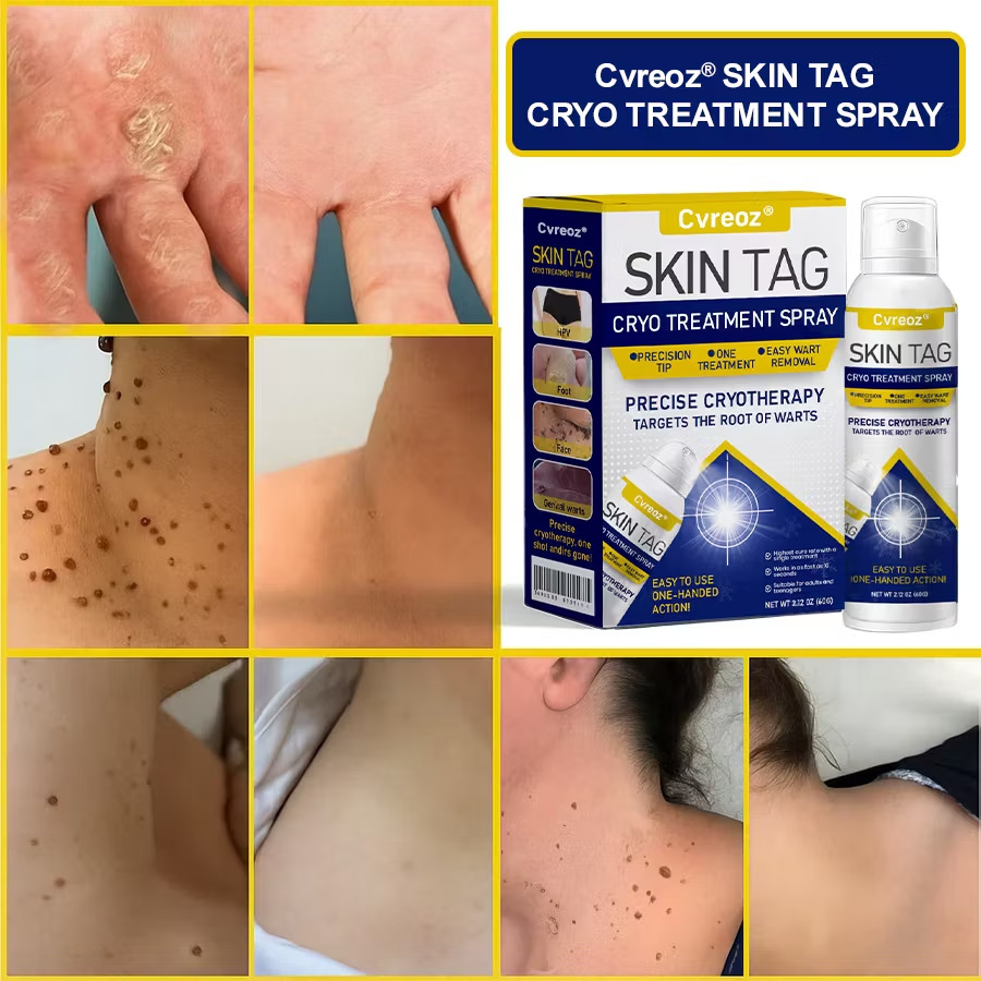 Cvreoz® skin tag cryo spray